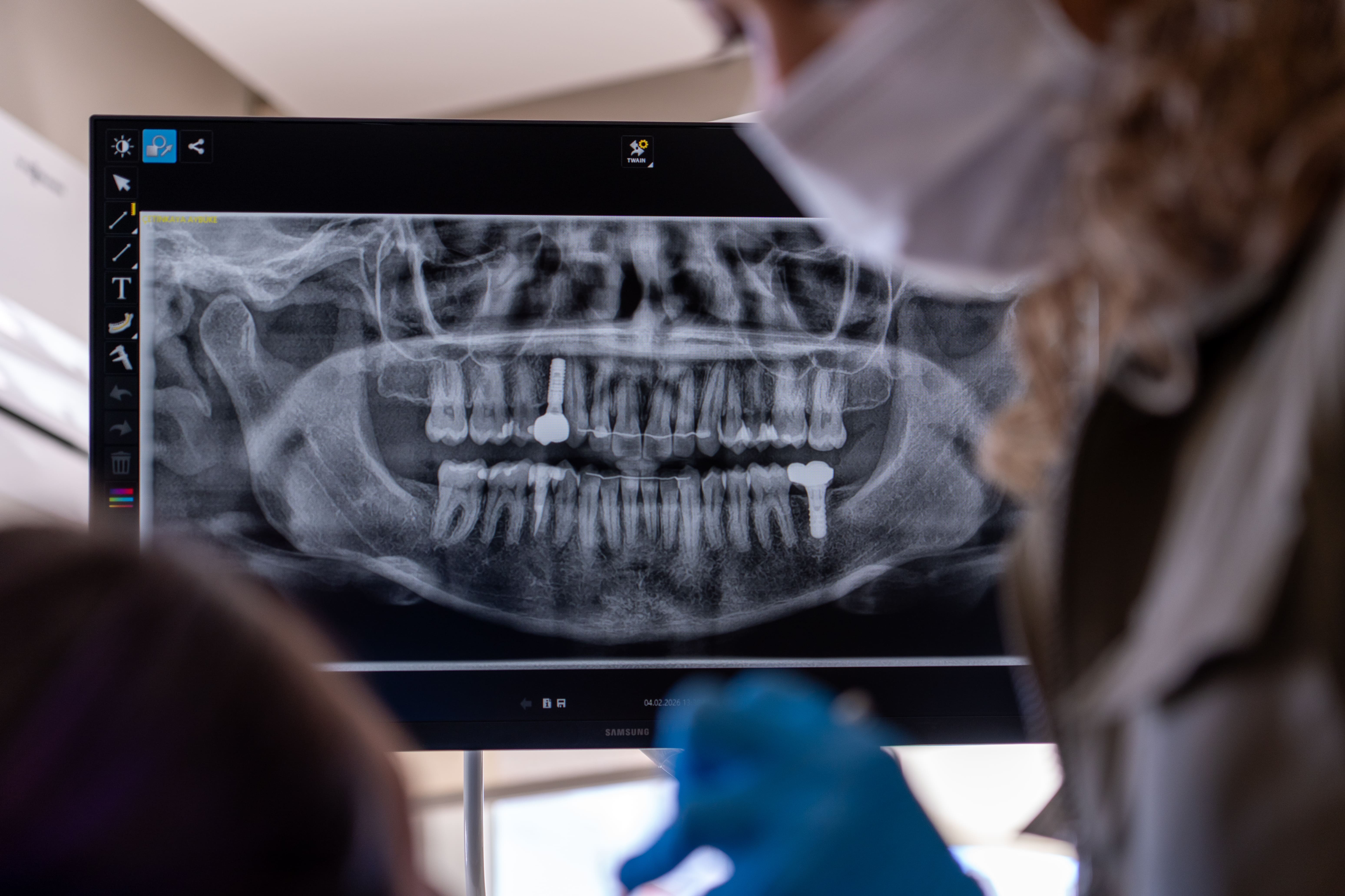 Panoramik Röntgen ile İmplant